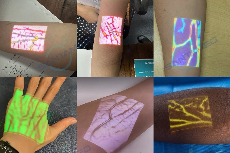 SVF-900 Vein Illumination Device SVF-900 Vein Illumination Device